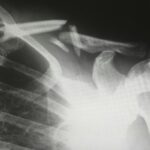 Xray of the Shoulder